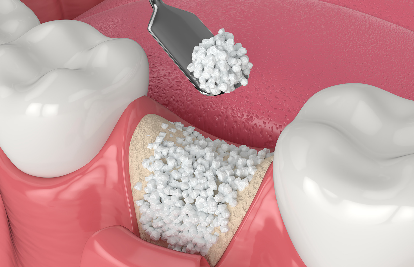 Render showing a bone grafting procedure at the dentist