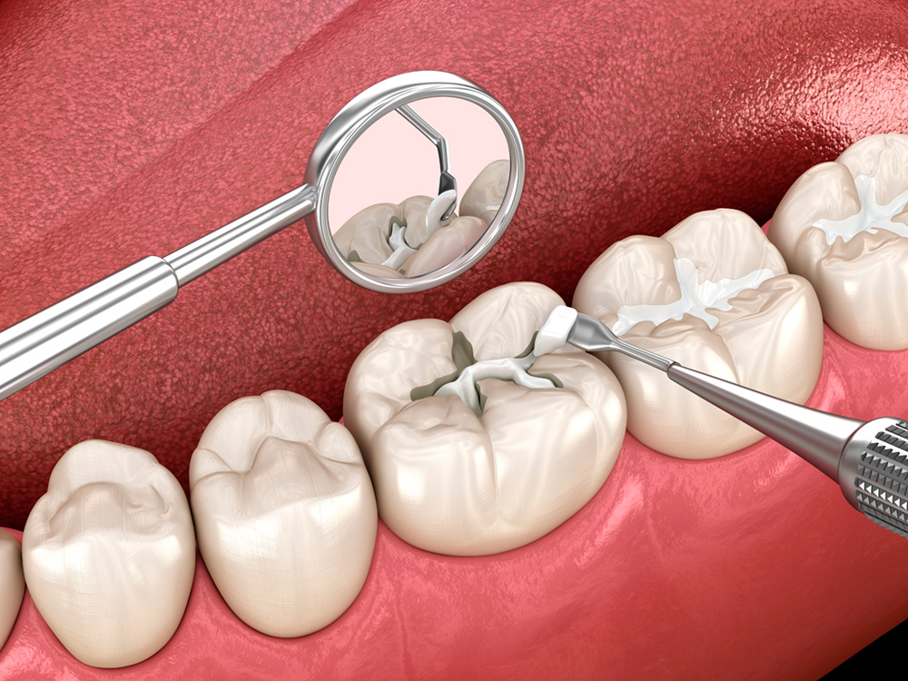 Render showing sealants being applied to a tooth