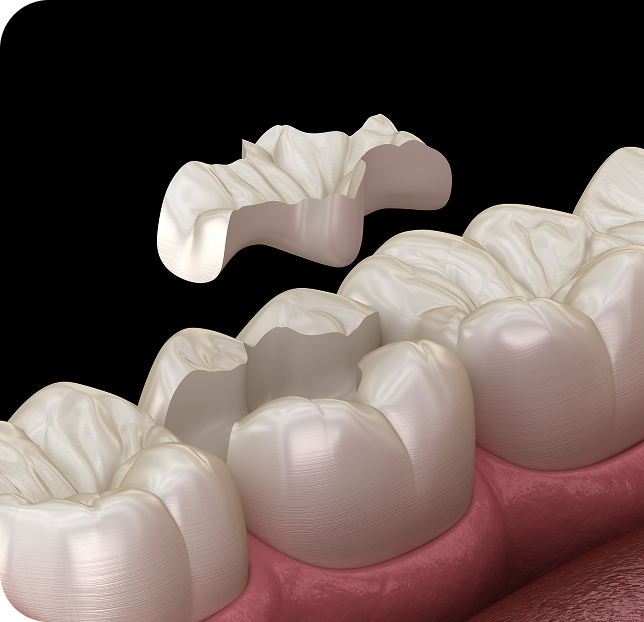 Render showing the restoration of a tooth, demonstrating the importance of general dentistry