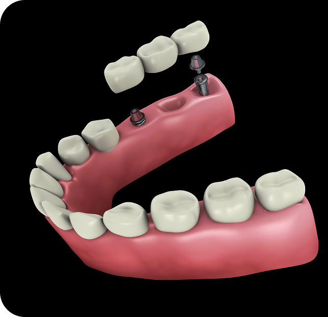Dental 3d model of implant bridges
