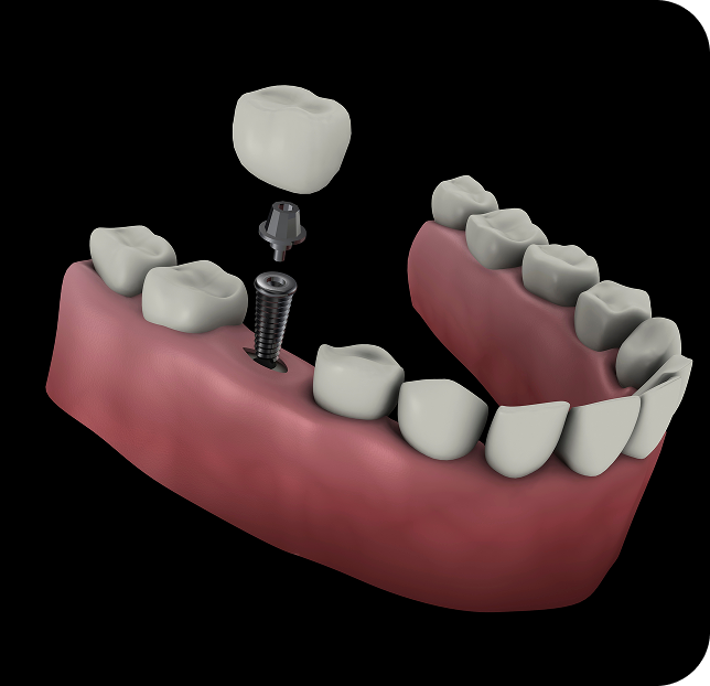 Demonstration of single implants