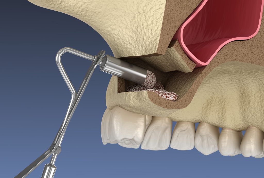 Render showing sinus lift at the dentist