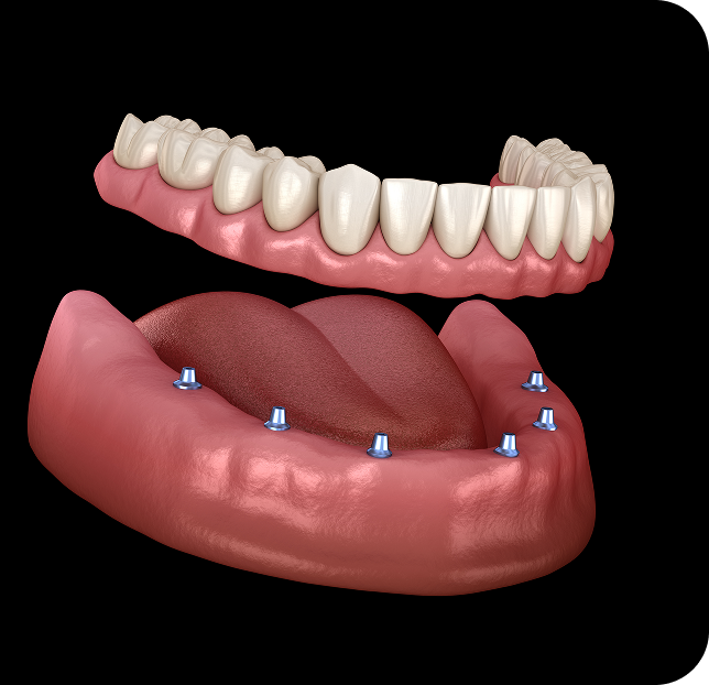 Render showing snap-in dentures