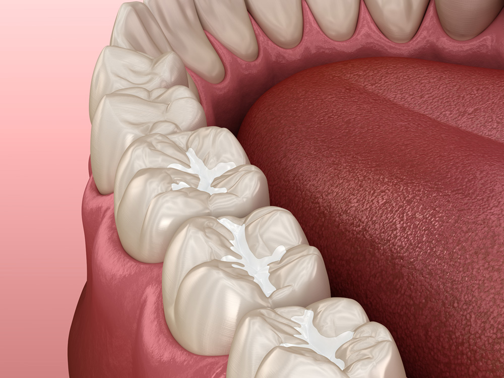 Render showing tooth-colored fillings on teeth