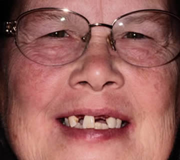 Middle-aged woman with missing upper teeth before dental procedure at Walton Dental Greenwood IN.