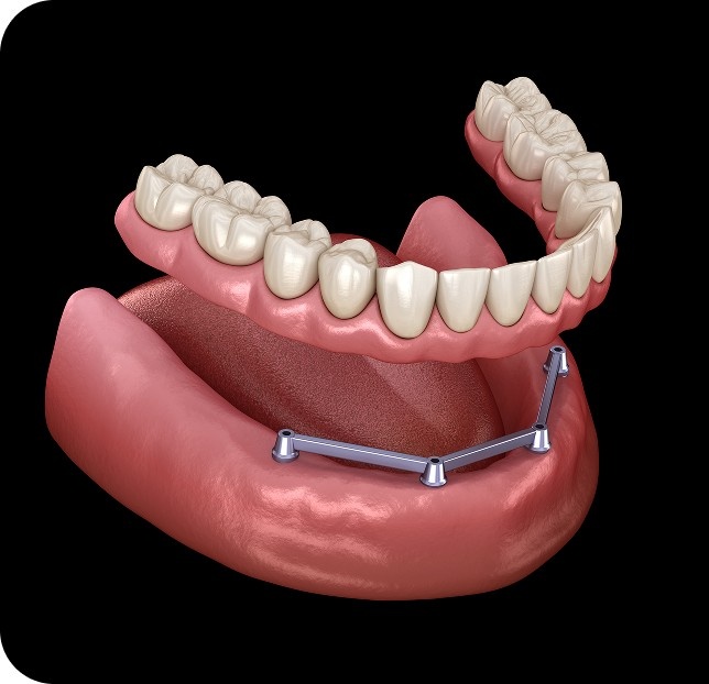 Image showing all-on-4 implants