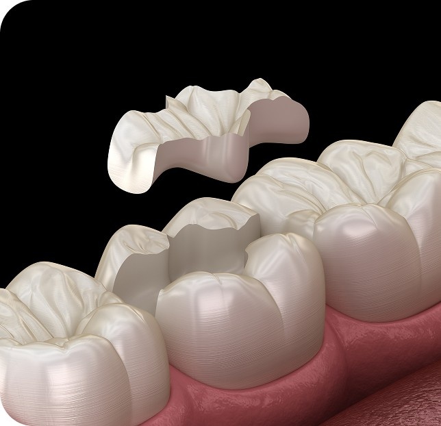 General Dentistry - Image of tooth restoration