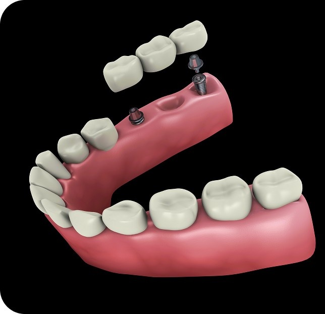 Image showing implant bridges