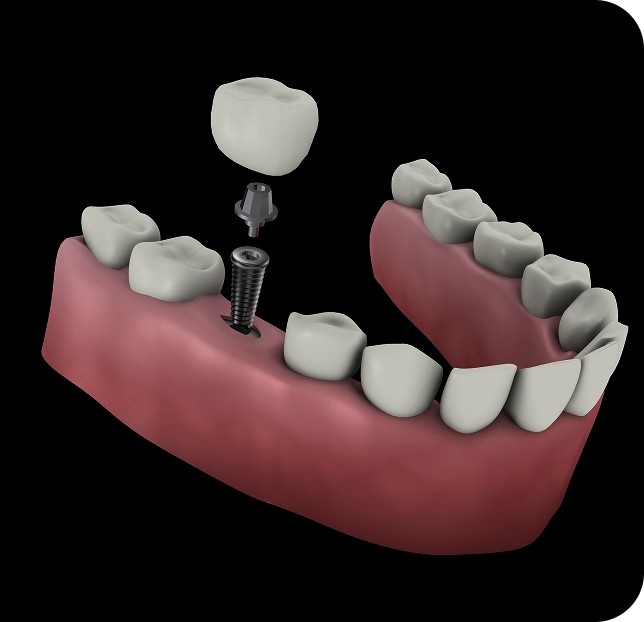 Image showing single implant