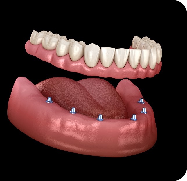 Image showing snap in dentures