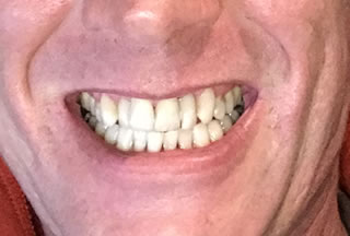 Smiling male patient displaying visibly improved white teeth after cosmetic dental care at Walton Dental Greenwood IN.