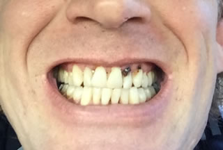 Close-up of adult male smile showing discolored teeth before whitening treatment at Walton Dental Greenwood IN.