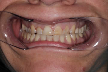 Adult male showing straightened teeth after orthodontic correction at Walton Dental Greenwood IN.