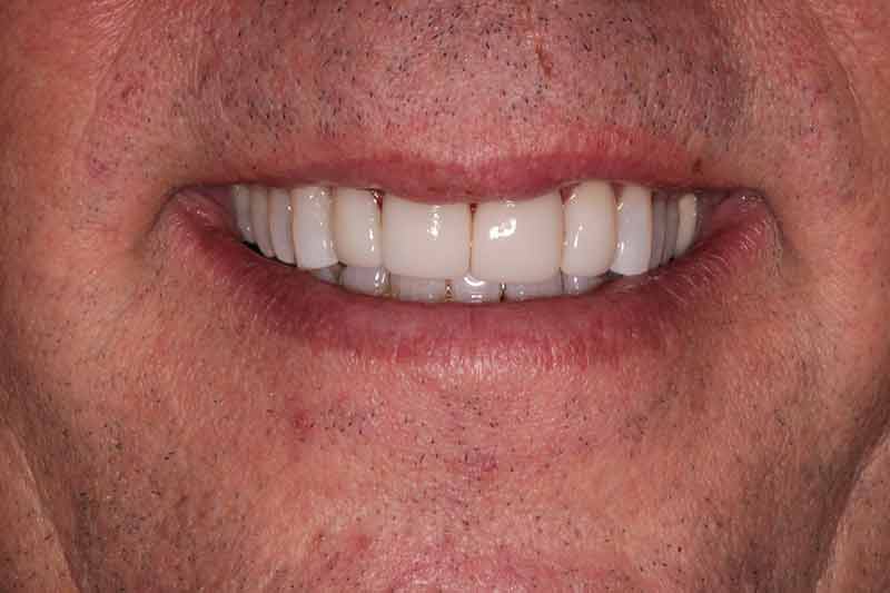 Bright smile of male patient with full zirconia crowns post dental makeover at Walton Dental Greenwood IN.