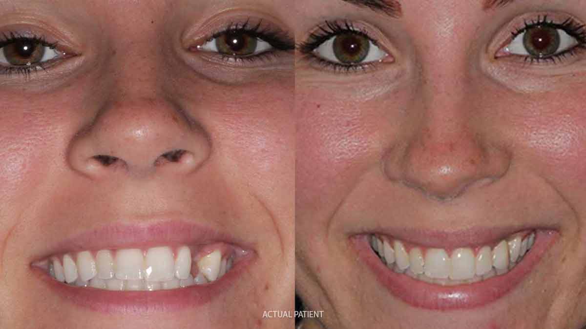 Before and after single tooth dental implants and crowns images