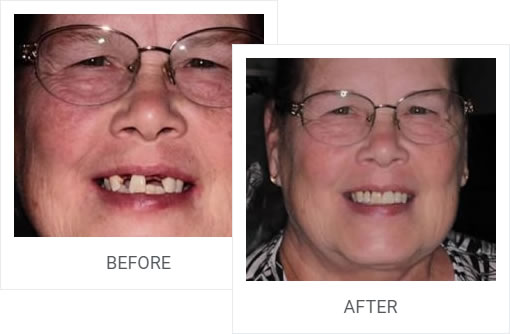Smile Makeover showing before and after dental implants