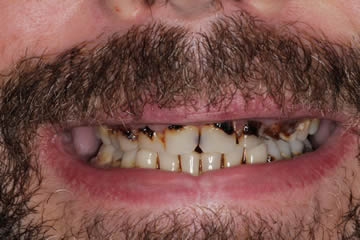 Visible dental erosion and broken teeth in male patient needing full dental care.