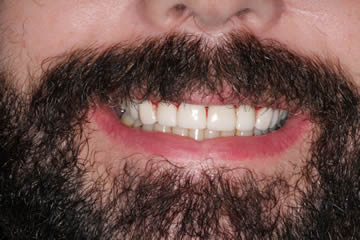 Male patient with white teeth and slight gum line recession smiling after treatment.