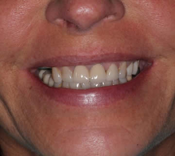 Patient showing aligned and white teeth post Invisalign treatment at Walton Dental Greenwood IN.