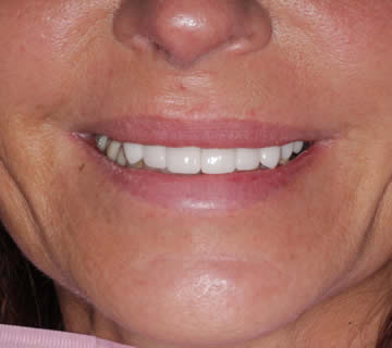 Female patient with symmetrical and bright teeth after dental makeover at Walton Dental Greenwood IN.