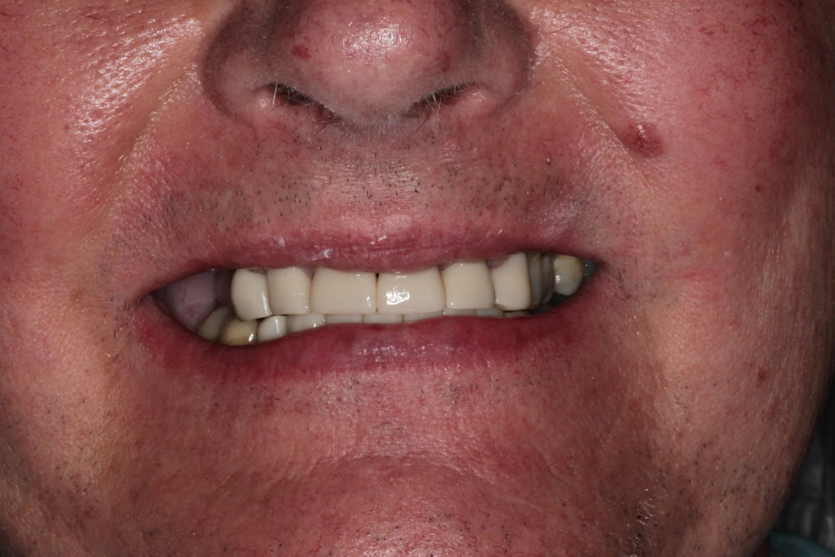 Patient after receiving full dental implant bridge showing aligned and restored teeth at Walton Dental Greenwood IN.