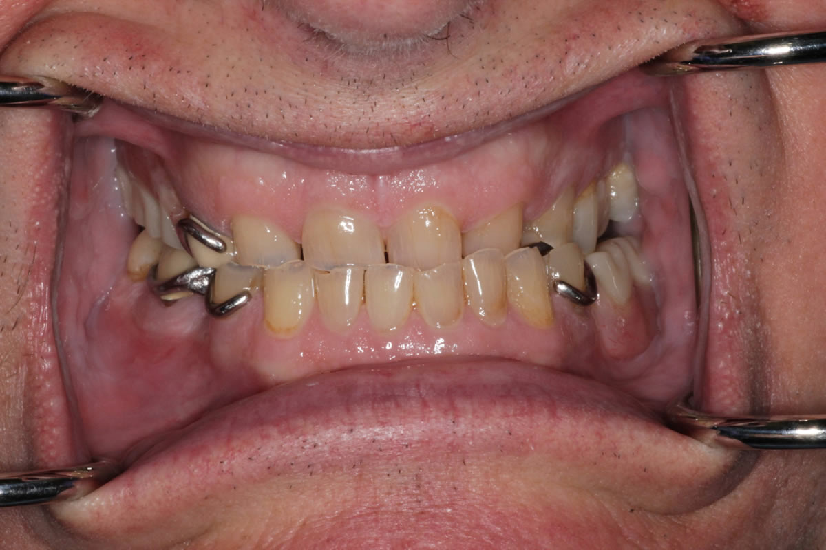 Adult patient displaying broken and discolored teeth before emergency dental care at Walton Dental Greenwood IN.