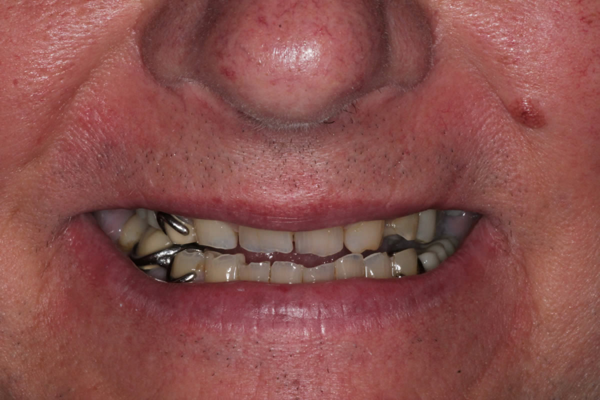 Smiling adult showing slightly yellowed teeth with minor crowding before cosmetic dental treatment.