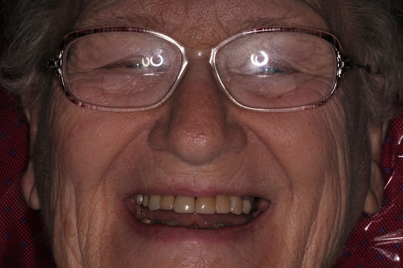 Close-up of elderly man's bright smile after dental restoration at Walton Dental Greenwood in Greenwood IN.