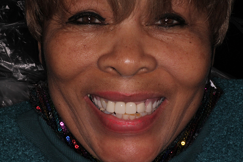 Elderly woman smiling with restored white teeth after full smile makeover at Walton Dental Greenwood in Greenwood IN.