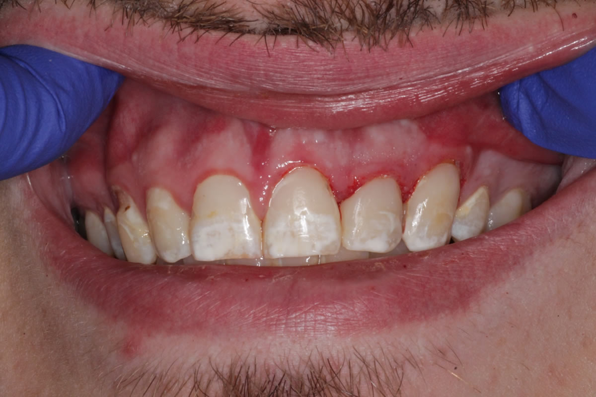 Close-up of male patient’s teeth showing minor plaque buildup and gum inflammation during exam.
