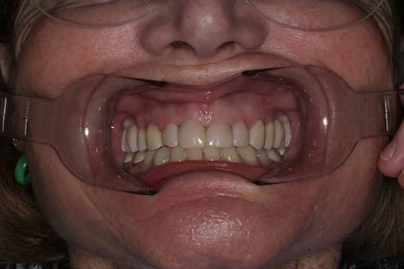 Full mouth view using retractor showing aligned teeth before cosmetic finishing at Walton Dental Greenwood IN.