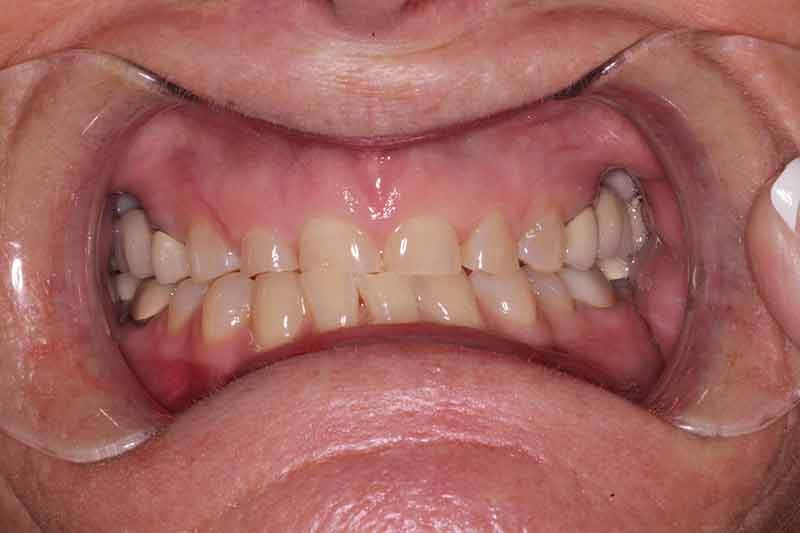 Close-up of upper and lower teeth with visible wear and crowding before dental treatment.