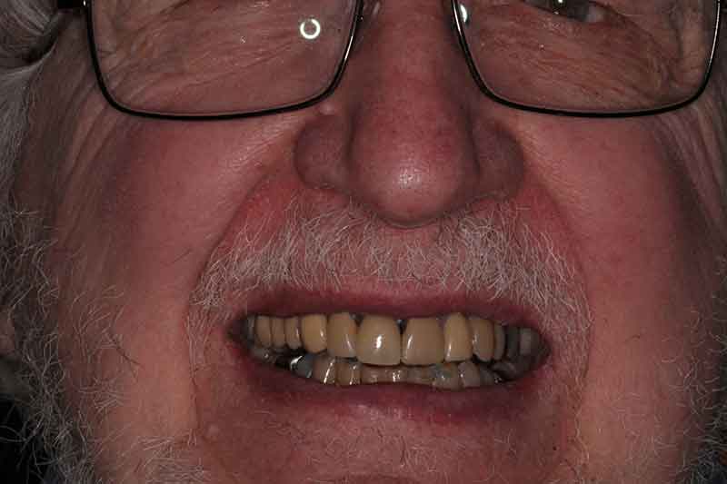 Elderly man with restored upper and lower teeth, smiling after full dental rehabilitation.