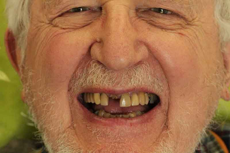Elderly man smiling with multiple missing upper and lower teeth before dental work.