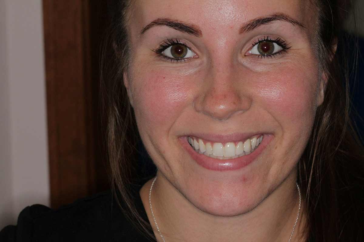 Female patient with radiant smile and healthy gum line after dental realignment.