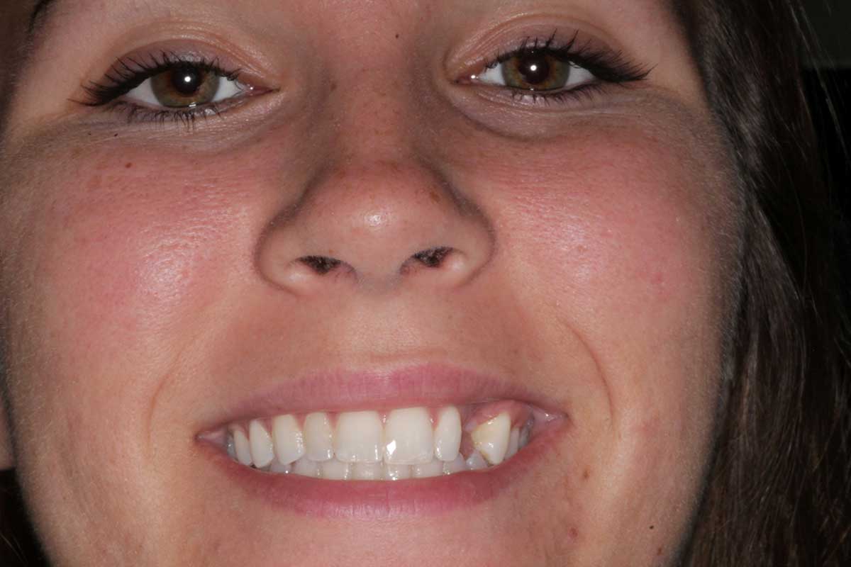 Patient mouth pulled back with dental instrument to assess bite and gum health.