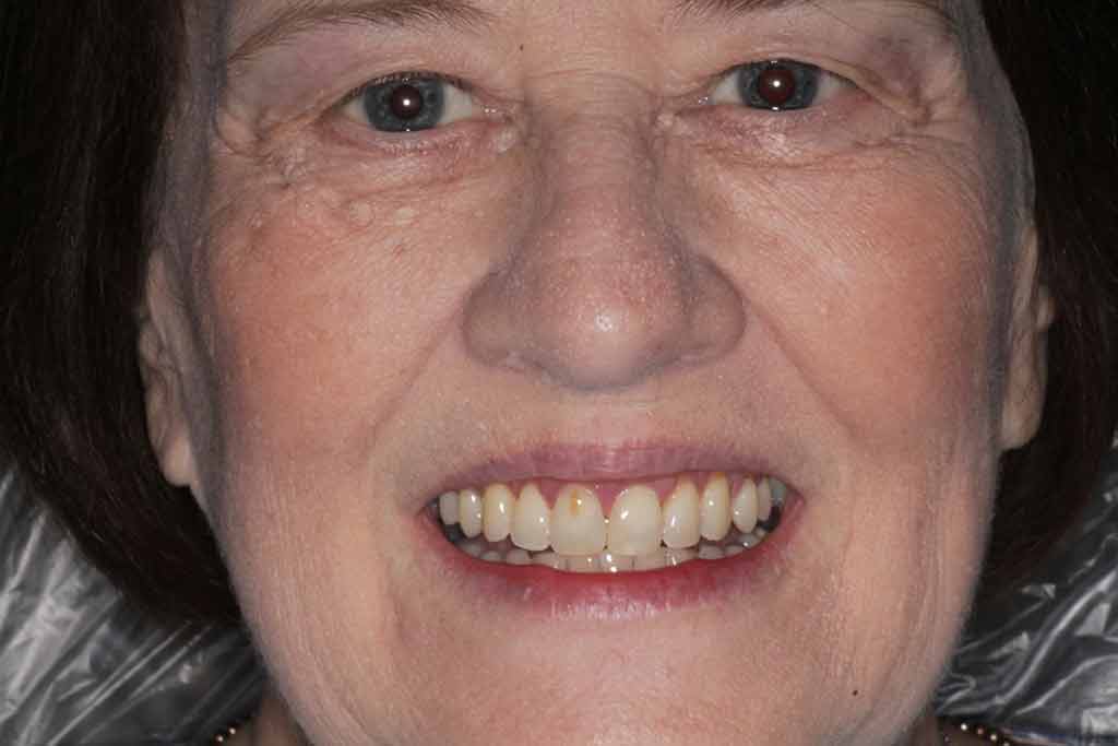 Elderly female patient with restored smile and balanced teeth shade after full arch restoration.