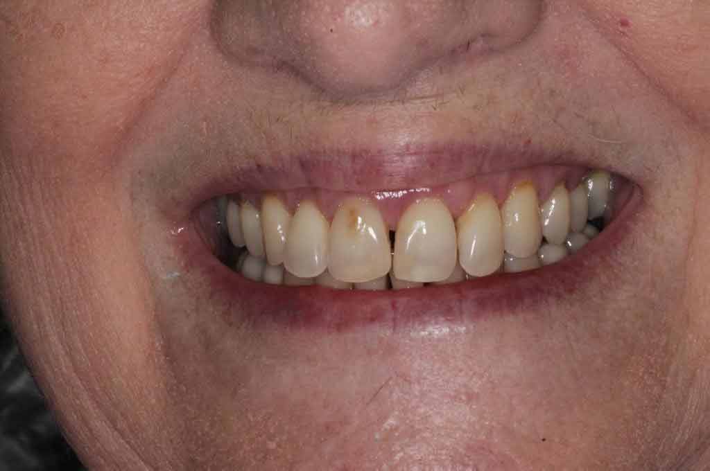 Middle-aged female smiling with partially restored teeth after receiving front restorations at Walton Dental.
