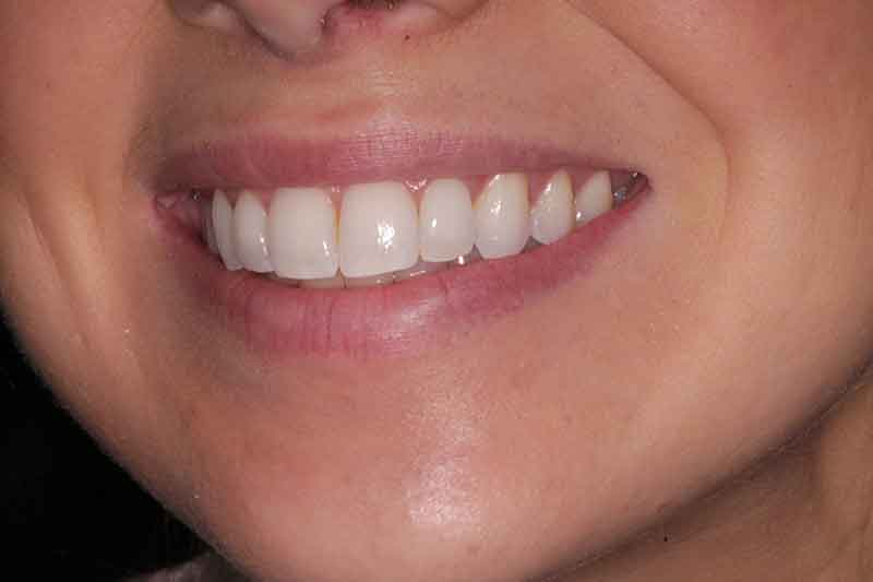 Close-up of a woman’s perfectly aligned and whitened teeth after cosmetic dental treatment at Walton Dental Greenwood in Greenwood IN.