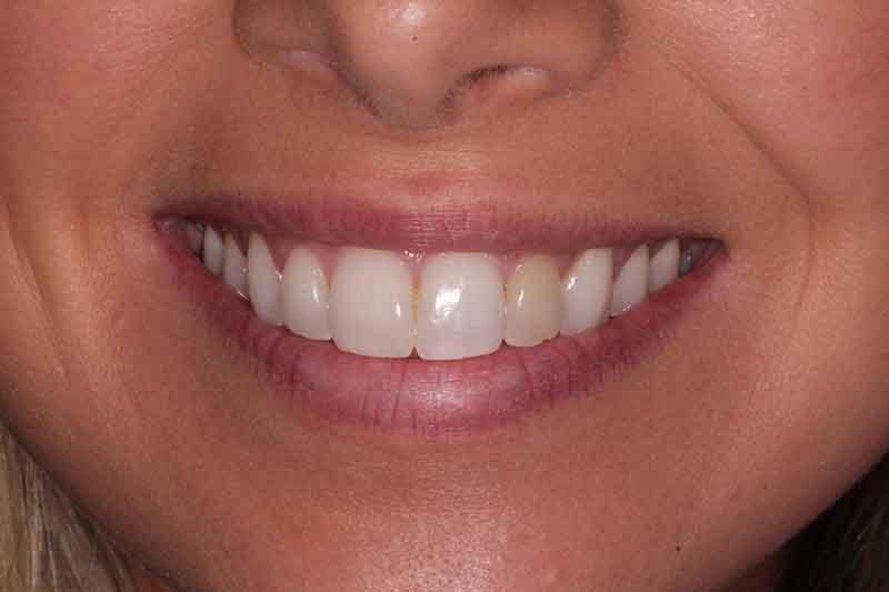 Close-up of a woman's discolored front tooth before dental treatment at Walton Dental Greenwood in Greenwood IN.