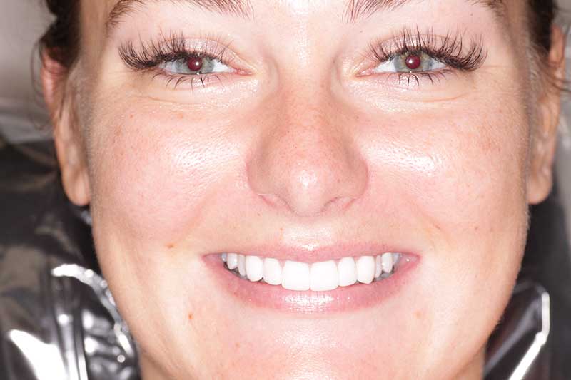 Woman smiling confidently with completed dental restoration and straight white teeth.