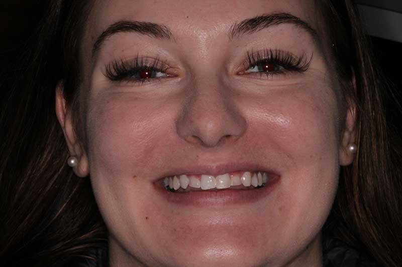 Young woman smiling after full-mouth dental restoration with bright, even teeth.