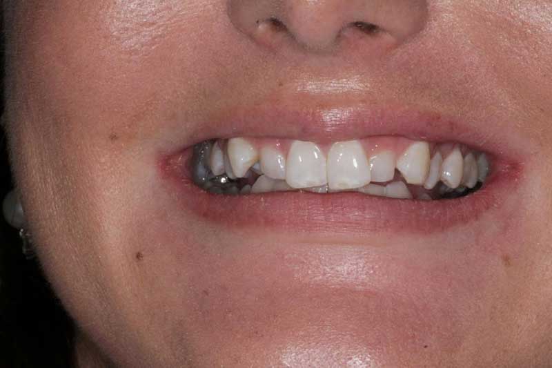Close-up of woman’s mouth smiling with completed dental bridge or implant-supported teeth.