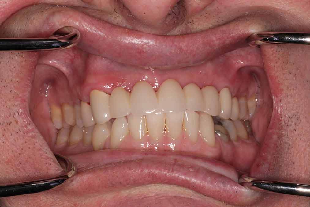 Full set of dentures fitted into lower jaw post-surgery at Walton Dental Greenwood IN.