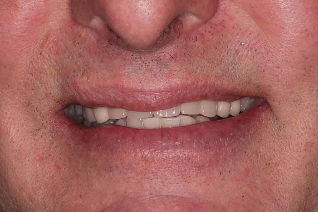 Post-recovery image showing closed lips and restored front teeth alignment.