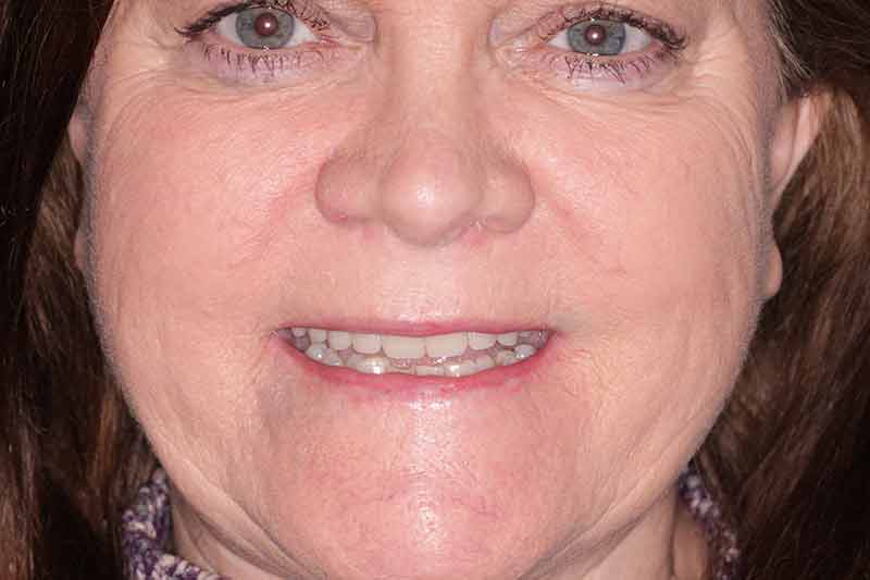 Elderly woman smiling after dental restoration with full upper dentures or implants.