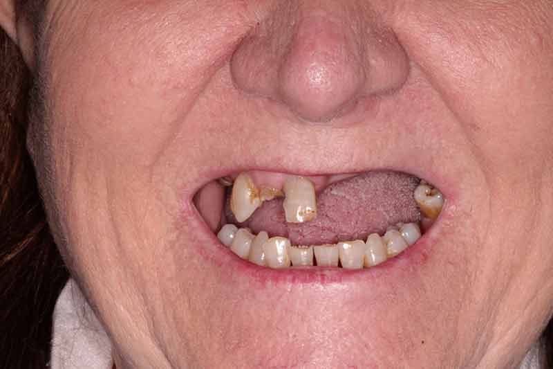 Male patient showing missing upper teeth and oral preparation before implant placement.