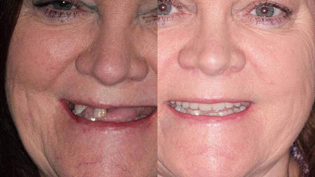 before and after All-on-X (Four or Six) dental implants