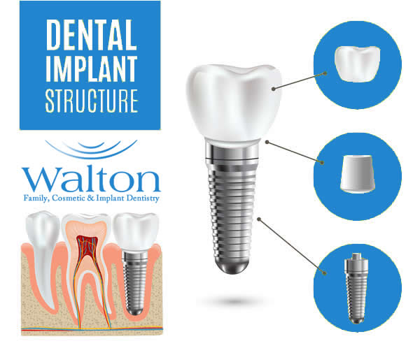 Image showing dental implant structure