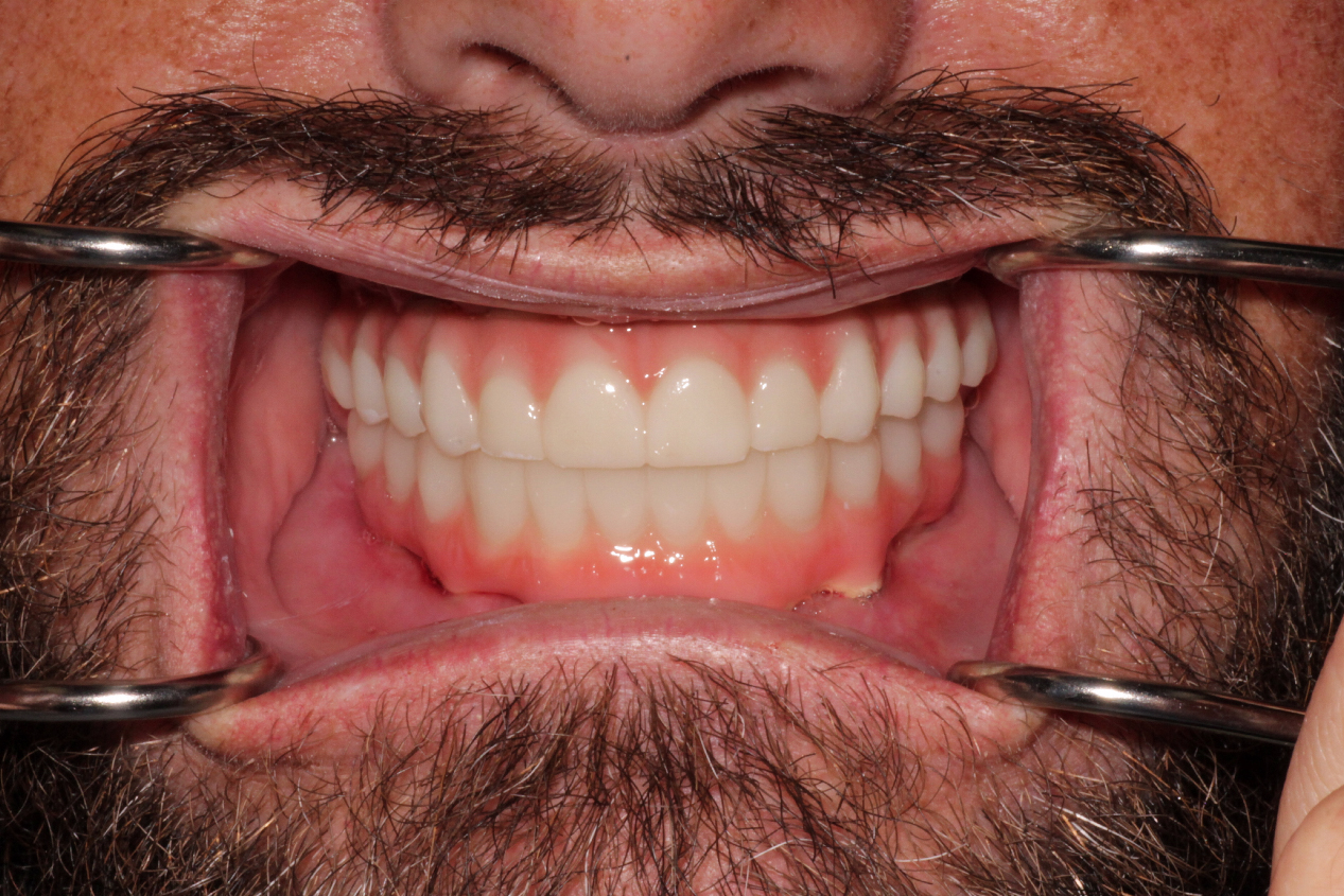 Male patient after receiving Full Arch All-on-X Implants in Greenwood, IN